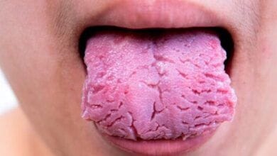 lengua agrietada