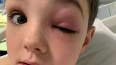 Nino de 9 anos casi pierde la vista tras contraer