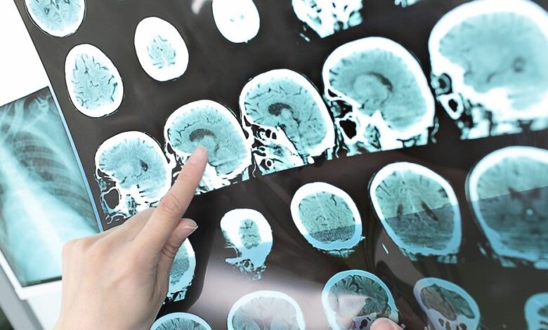 El primer escaneo de un cerebro humano moribundo revela que la vida en realidad puede "pasar ante tus ojos"