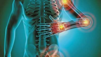 ¿Qué es la Inflamación Crónica? Síntomas, causas y cura 6 ¿Que es la Inflamacion Cronica Sintomas causas y cura