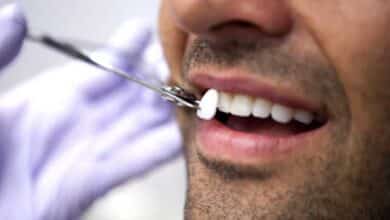 ¿Qué son las carillas dentales y qué tipos hay? 10 carillas-dentales-hombre