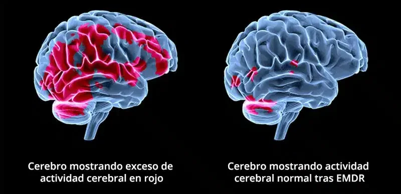 Integración de la terapia EMDR en el tratamiento del dolor crónico 2 terapia EMDR en el tratamiento del dolor crónico