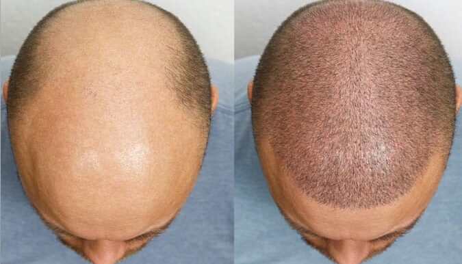 Guía completa de tratamientos estéticos innovadores: de moldeado corporal a injerto de cabello y terapias Fotoage 3 injerto de cabello