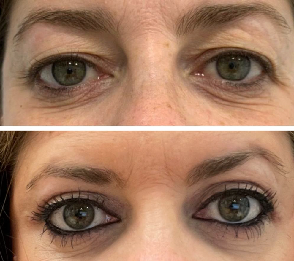 Blefaroplastia antes y despues
