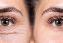 Blefaroplastia