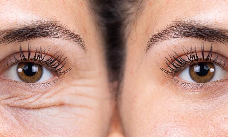 Blefaroplastia