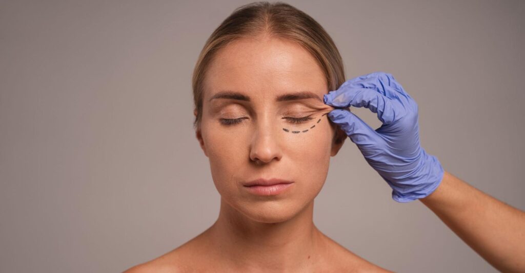 Blefaroplastia ojos cerrados